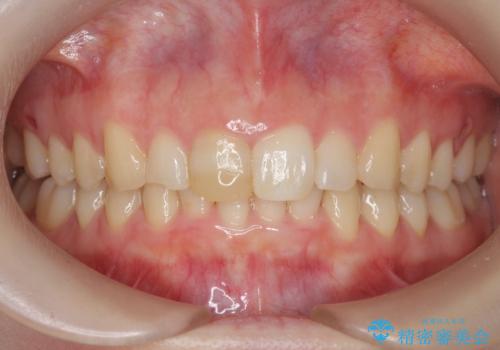 前歯のがたつき　深い噛み合わせを改善したいの症例 治療後