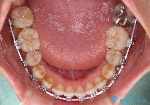 前歯の反対咬合 急速拡大装置とワイヤー装置であっという間の矯正治療の治療中