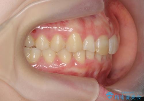 前歯のがたつき 深い噛み合わせを改善したいの治療後
