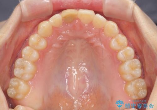 前歯のがたつき 深い噛み合わせを改善したいの治療後