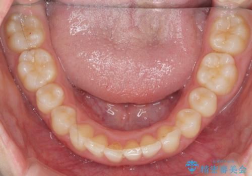 前歯のがたつき　深い噛み合わせを改善したいの治療後