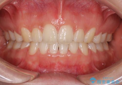 口元を下げてすっきりさせたい ワイヤー抜歯矯正で口元の改善の治療後