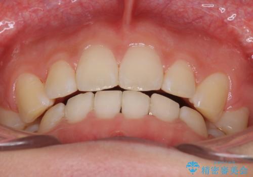 口元を下げてすっきりさせたい ワイヤー抜歯矯正で口元の改善の治療後