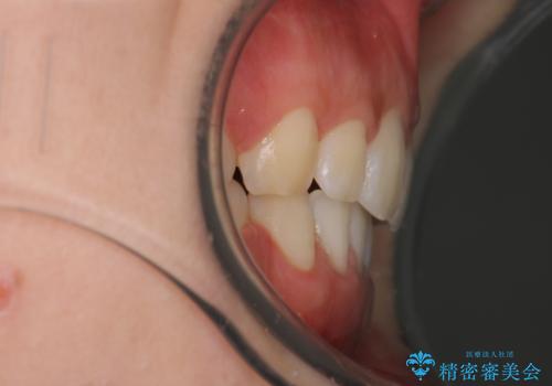 口元を下げてすっきりさせたい ワイヤー抜歯矯正で口元の改善の治療後