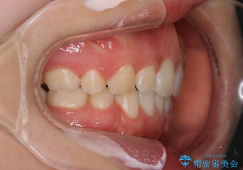 口元を下げてすっきりさせたい ワイヤー抜歯矯正で口元の改善の症例 治療後