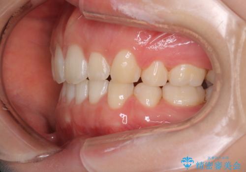 口元を下げてすっきりさせたい ワイヤー抜歯矯正で口元の改善の治療後