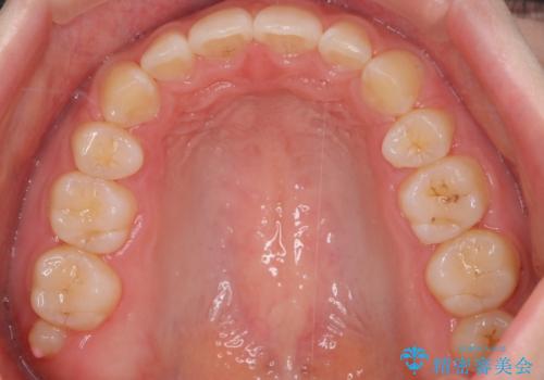 口元を下げてすっきりさせたい ワイヤー抜歯矯正で口元の改善の治療後