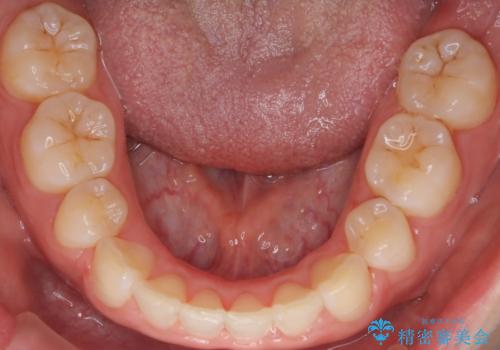 口元を下げてすっきりさせたい ワイヤー抜歯矯正で口元の改善の治療後
