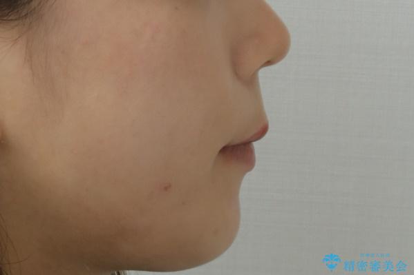 口元を下げてすっきりさせたい ワイヤー抜歯矯正で口元の改善の治療後(顔貌)