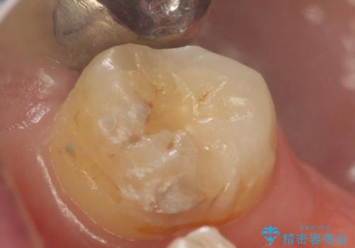 奥歯のザラザラが気になるの治療中