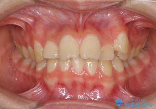目立つ八重歯を治したい　インビザラインによる矯正治療の症例 治療前