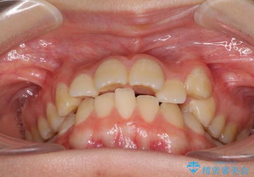 目立つ八重歯を治したい インビザラインによる矯正治療の治療前
