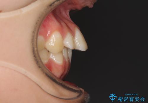 目立つ八重歯を治したい インビザラインによる矯正治療の治療前