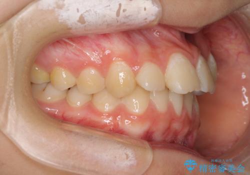 目立つ八重歯を治したい インビザラインによる矯正治療の治療前