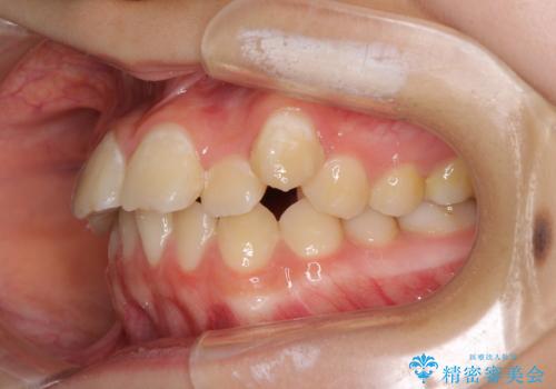 目立つ八重歯を治したい　インビザラインによる矯正治療の治療前