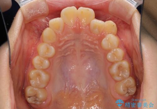 目立つ八重歯を治したい インビザラインによる矯正治療の治療前