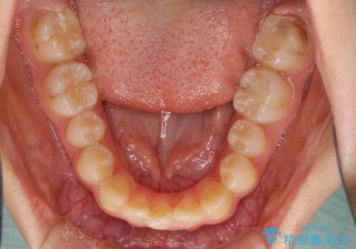 目立つ八重歯を治したい インビザラインによる矯正治療の治療前