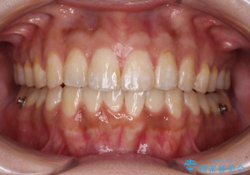 上下前歯の前歯と腫れやすい歯肉　インビザライン矯正で改善の治療中
