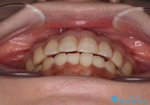 上下前歯の前歯と腫れやすい歯肉 インビザライン矯正で改善の治療中
