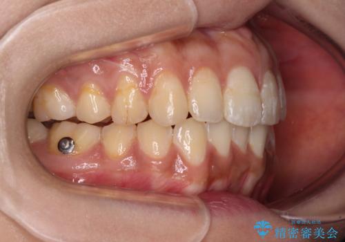 上下前歯の前歯と腫れやすい歯肉　インビザライン矯正で改善の治療中