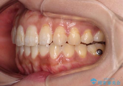 上下前歯の前歯と腫れやすい歯肉 インビザライン矯正で改善の治療中