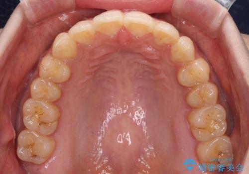 上下前歯の前歯と腫れやすい歯肉 インビザライン矯正で改善の治療中