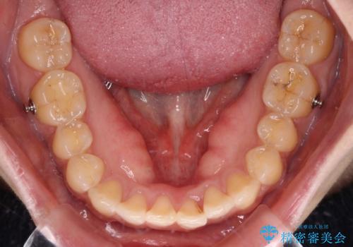 上下前歯の前歯と腫れやすい歯肉 インビザライン矯正で改善の治療中