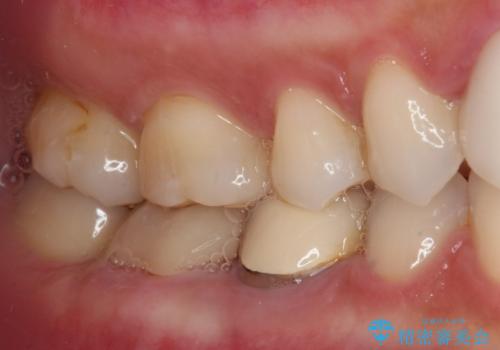 抜歯と言われた奥歯を残したい　奥歯を保存するセラミック治療の治療後