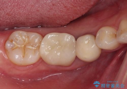 抜歯と言われた奥歯を残したい　奥歯を保存するセラミック治療の症例 治療後
