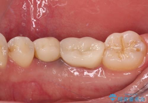 抜歯と言われた奥歯を残したい 奥歯を保存するセラミック治療の治療後