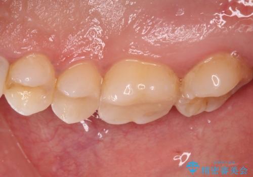 抜歯と言われた奥歯を残したい 奥歯を保存するセラミック治療の治療後