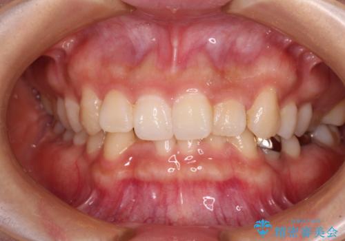 ディープバイトとデコボコを解消 インビザライン矯正の症例 治療前