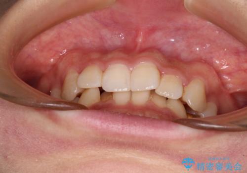 ディープバイトとデコボコを解消 インビザライン矯正の治療前
