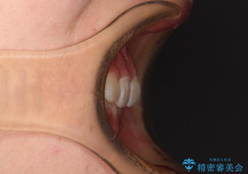 ディープバイトとデコボコを解消 インビザライン矯正の治療前