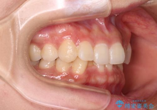 ディープバイトとデコボコを解消 インビザライン矯正の治療前
