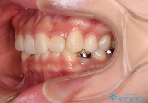 ディープバイトとデコボコを解消 インビザライン矯正の治療前