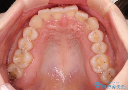 ディープバイトとデコボコを解消 インビザライン矯正の治療前