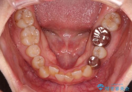 ディープバイトとデコボコを解消 インビザライン矯正の治療前