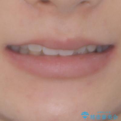 ディープバイトとデコボコを解消 インビザライン矯正の治療前(顔貌)