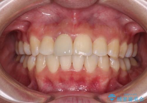 虫歯と抜いたままの奥歯とデコボコの前歯　総合歯科治療の症例 治療後