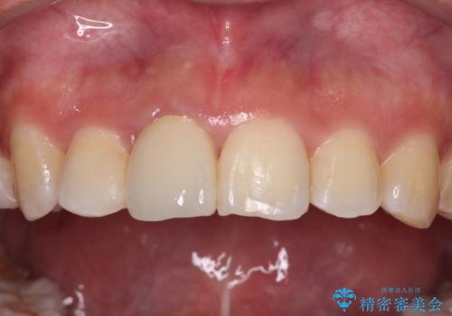 虫歯と抜いたままの奥歯とデコボコの前歯 総合歯科治療の治療後