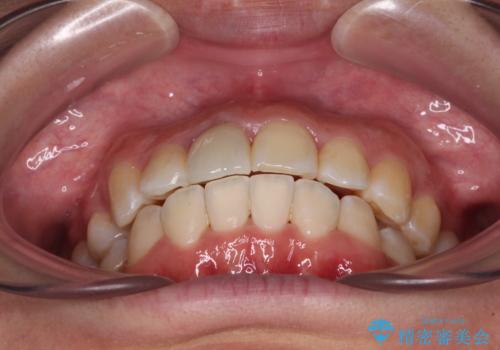 虫歯と抜いたままの奥歯とデコボコの前歯 総合歯科治療の治療後