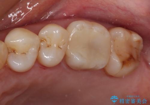 奥歯がしみる　セラミックインレーでの虫歯治療の症例 治療後