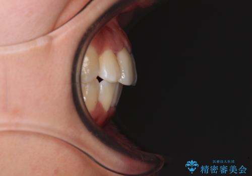 虫歯と抜いたままの奥歯とデコボコの前歯　総合歯科治療の治療後