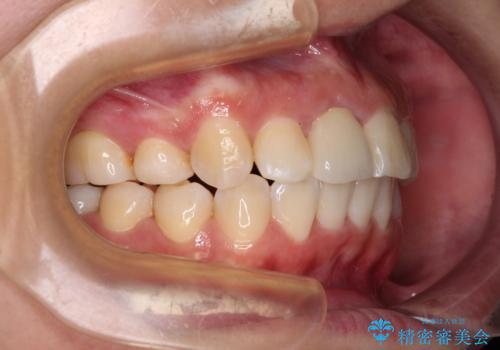 虫歯と抜いたままの奥歯とデコボコの前歯 総合歯科治療の治療後
