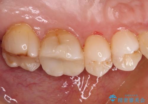 奥歯がしみる セラミックインレーでの虫歯治療の治療後