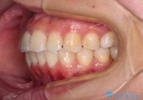虫歯と抜いたままの奥歯とデコボコの前歯 総合歯科治療の治療後