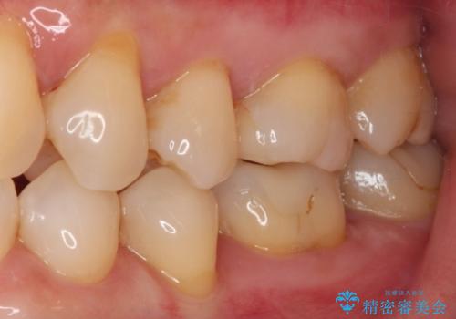 奥歯がしみる セラミックインレーでの虫歯治療の治療後