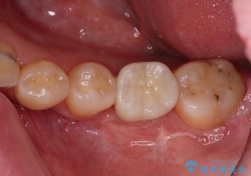 虫歯と抜いたままの奥歯とデコボコの前歯 総合歯科治療の治療後
