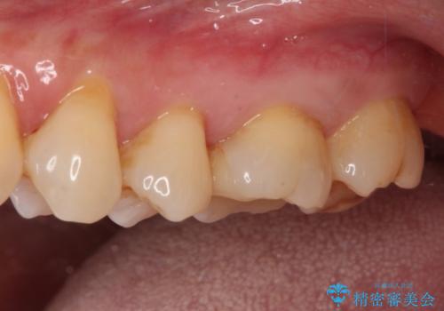 奥歯がしみる　セラミックインレーでの虫歯治療の治療後